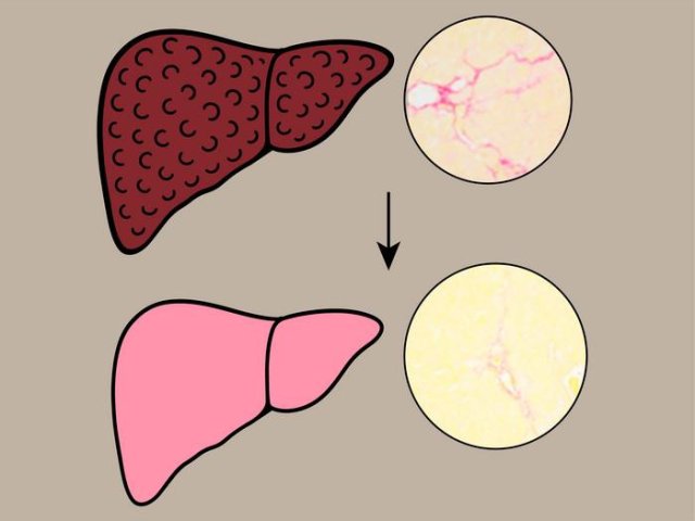 Лечение хной превращает печень с фиброзом в здоровую печень. Фото: Osaka Metropolitan University / Tsutomu Matsubara